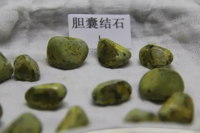 以前都是保胆取石，为啥现在查出胆结石，就要切除胆囊？令人深思