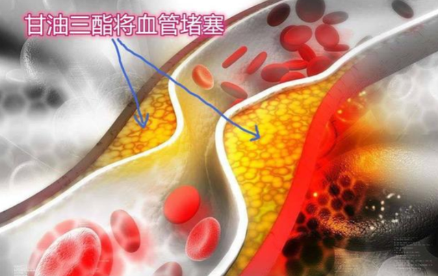 “甘油三酯大户”被揪出，医生提醒：能不吃就不吃，别不听劝