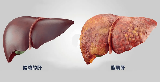 高血脂不能吃豆腐？医生：3种降脂食物常吃，血脂“偷偷”下降