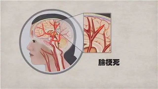 脑梗“源头”已发现，肥肉榜上无名，第1名很多人几乎天天在吃