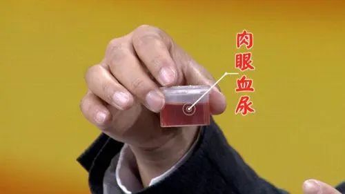 34岁男子患尿毒症，依靠透析活命：后悔年轻时太无知，不懂节制