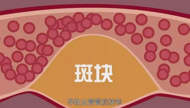 高血脂的“源头”，肥肉排末位，第1名很多人都爱吃