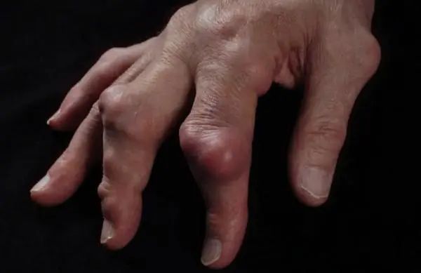 洋葱是高尿酸“元凶”？医生提醒：不想尿酸升高，3物趁早远离