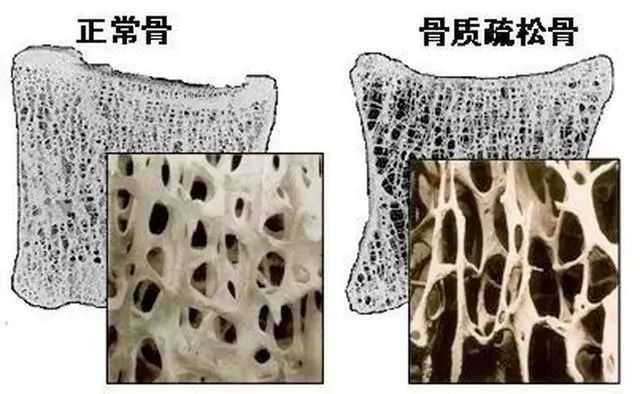 医生建议停止食用：或比味精伤骨骼，不想骨头呈蜂窝，尽量少吃