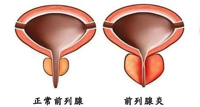 大蒜是前列腺炎的“发物”吗？医生建议：保护前列腺，多吃这5物