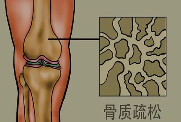 老年人摔一跤，结果有多严重？过了60岁，3种食物不要不舍得吃