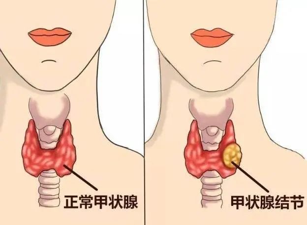 甲状腺结节可以吃白菜吗？医生：不想结节滋长，3种菜莫贪吃
