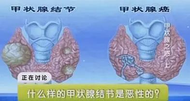 医生提醒：小米和它一起煮，堪称结节“加速器”，甲状腺患者忌口