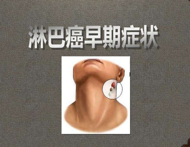 从癌症晚期到肿瘤消失，李开复抗癌9年无复发，4个经验值得借鉴
