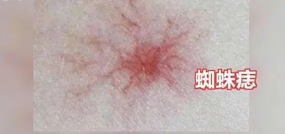 伤肝的“素食”已揭晓，大蒜没上榜，肝不好的人，建议早忌口