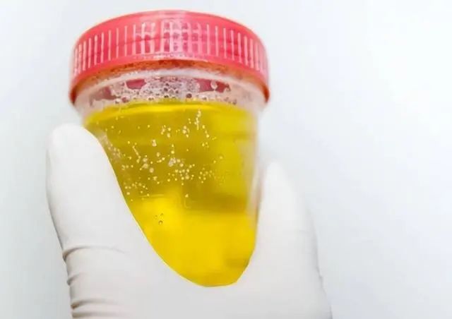 血糖升高，看尿就知道？尿液有存在3个表现，或血糖升高的信号
