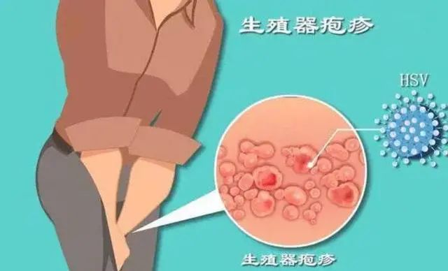 9种病能通过“性传播”你清楚几个？思想开放的人，建议了解一下