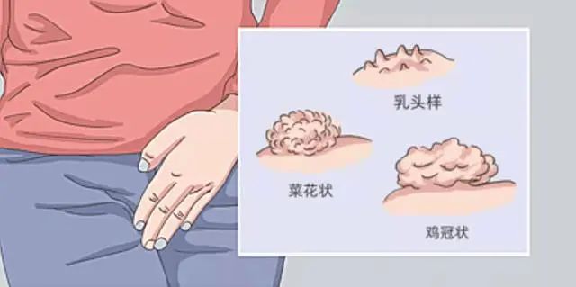 9种病能通过“性传播”你清楚几个？思想开放的人，建议了解一下