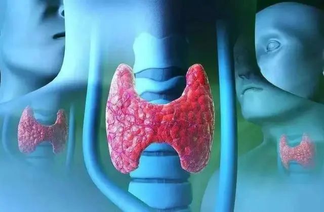 甲状腺结节，不能碰“羊肉汤”？医生：保护甲功，3类早餐应少吃