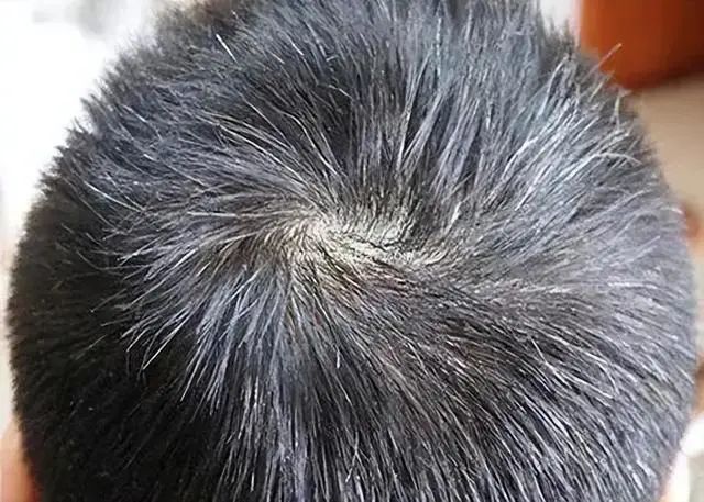 白发长在哪，病就出在哪？长在前额、后脑勺，两鬓，分别代表什么