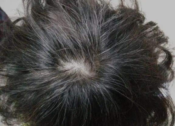 白发长在哪，病就出在哪？长在前额、后脑勺，两鬓，分别代表什么