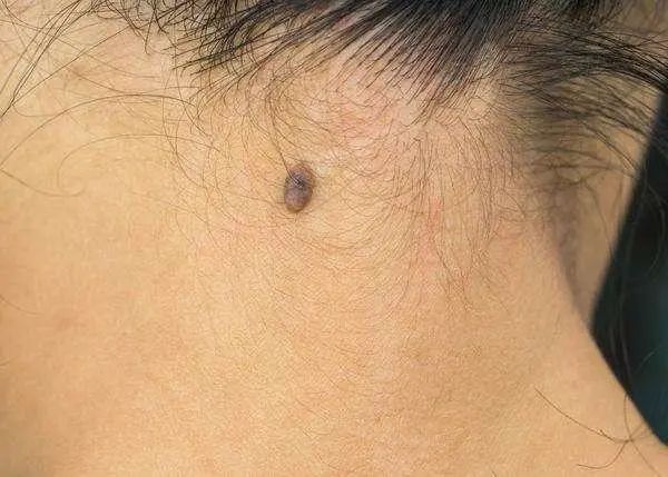 医生提醒：若黑痣长在这3个部位，要密切关注，及早做检查