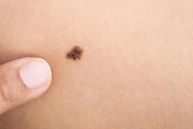 医生提醒：若黑痣长在这3个部位，要密切关注，及早做检查