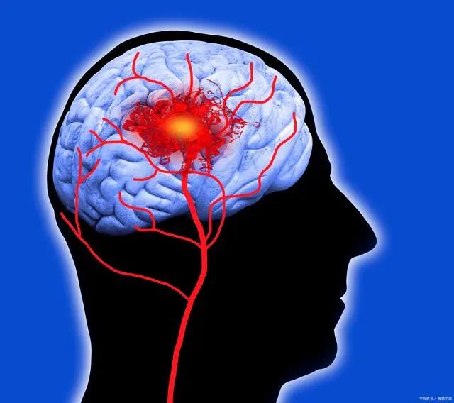 4个症状暗示“脑供血不足”！老了不想脑梗，提前做好4件事