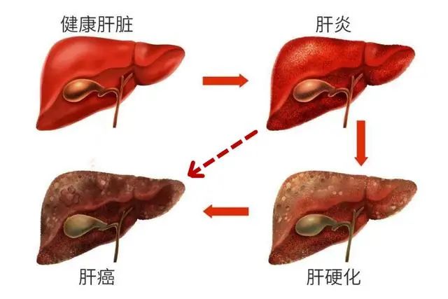 肝开始变硬，头部会有3个异常，若一个也没有，说明肝脏还很健康