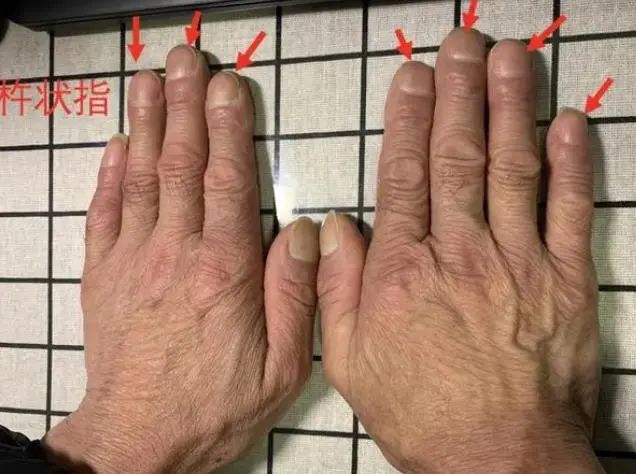 吸烟的人，若发现身上3处“凸起”，建议提高警惕，早查肺功能