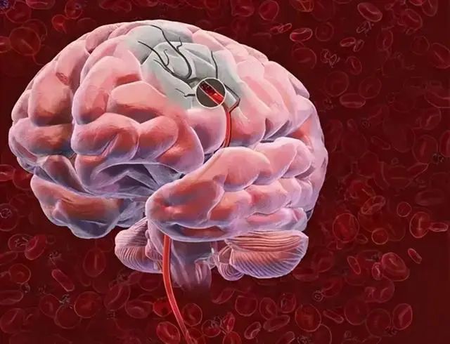 脑梗是拖出来的？医生提醒：6个表现或是脑梗的前兆，请引起重视
