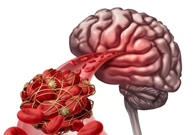 脑梗是拖出来的？医生提醒：6个表现或是脑梗的前兆，请引起重视
